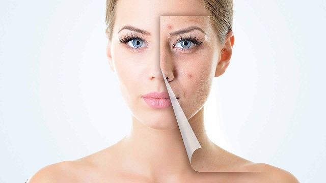 Effective Ways to Treat the Acne Scarring