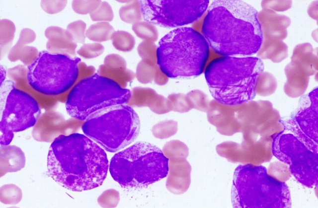 early symptoms of acute lymphoblastic leukemia