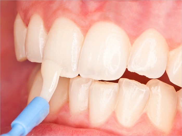 Fluoride Varnish