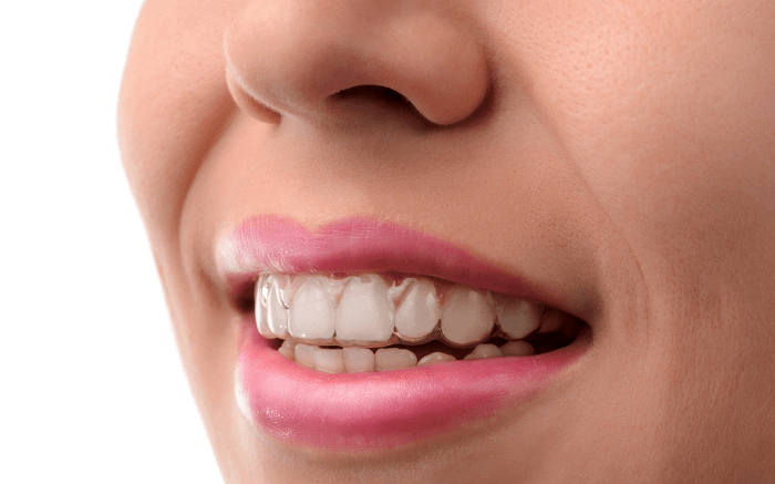 Smile With Invisalign