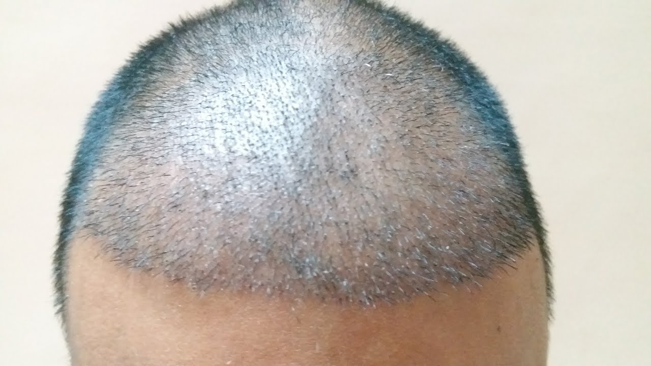 Hair Transplant tips