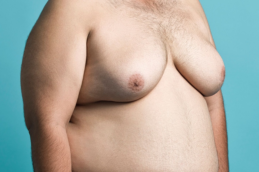 The Psychological Effects of Gynecomastia on Teens