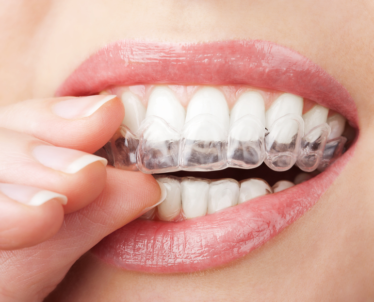 5 Interesting Things to Know About Clear Aligners and Their Cost