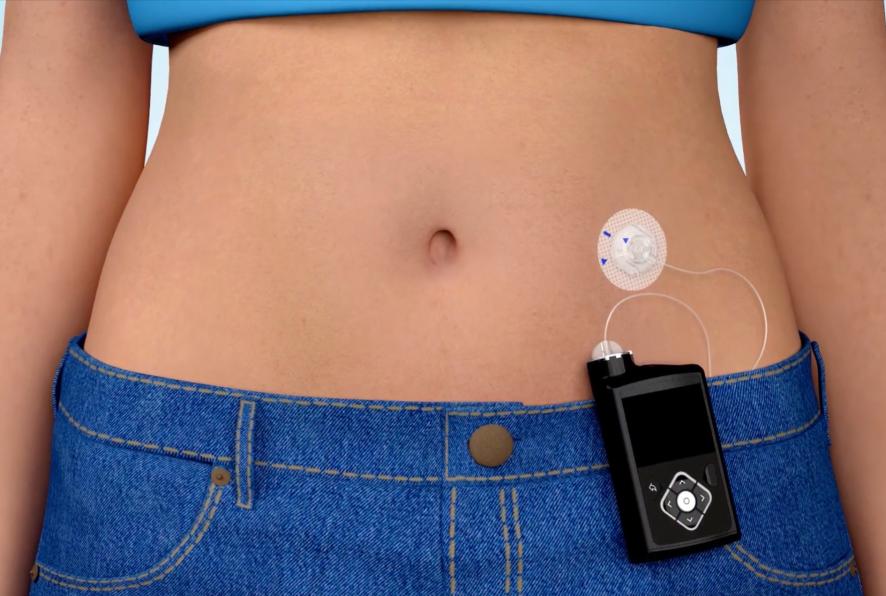 What Is An Insulin Pump Used For