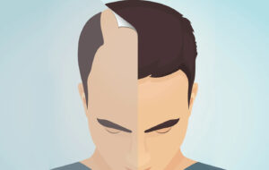 What Type of Hair Transplant Is Best for You