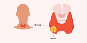 Thyroid-Cancer