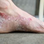 Eczema