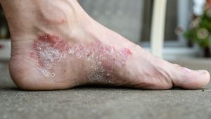 Eczema