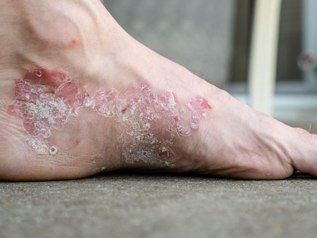 Eczema