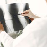 When Is It Safe to Resume Physical Activity After Knee Reconstruction